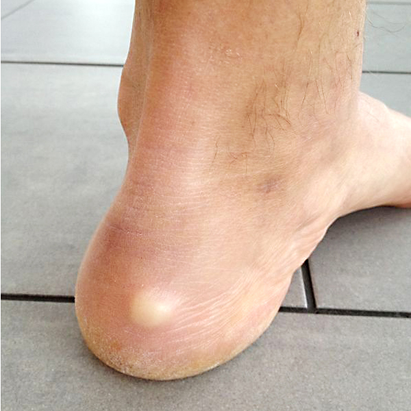 Lipoma on the heel